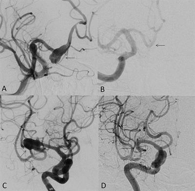 Editorial: Advances in flow-diversion devices for cerebral aneurysms